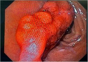 Upper GI endoscopy, in which a pedunculated polyp, approximately 4 cm in diameter, can be seen in the duodenal bulb in the first part of the duodenum, with signs of active bleeding.
