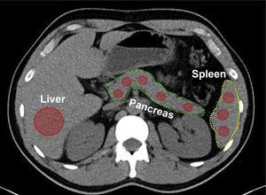 CAT scan showing the calculation of the measurement of the liver parenchyma density in an extensive region of interest (ROI) in segments VI and VII.