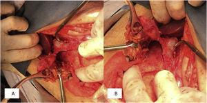 A, B) Gallbladder-abdominal wall fistulous tract.