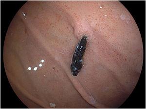 Endoscopic follow-up 5 years after endoclip placement.
