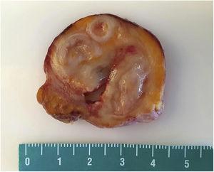 Gross appearance of the mass with multiple lumina.