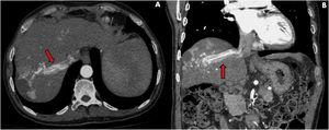 Computed tomography scan in the arterial phase: infiltrative and multinodular hepatocellular carcinoma with hypodense lesion between segments V/VIII measuring 60 mm at its largest diameter (necrosis). There is a contrast-enhanced thrombus within the right hepatic vein (red arrows) extending into the inferior vena cava. (A) Transverse plane, (B) Coronal plane.