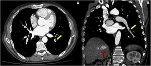 Computed tomography scan in the arterial phase. Yellow arrows show partial filling defects in the segmental arterial branches in the lower lobe of the left lung, corresponding to pulmonary embolism. There is no evidence of pulmonary metastasis. The red arrow reveals tumor thrombi within the right hepatic vein. (A) Transverse plane; (B) Coronal plane.