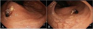 A) Dieulafoy’s lesion in the rectum. B) Retroflexed view of Dieulafoy’s lesion.