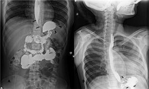 Barium swallow. A) Hollow arrows: marked narrowing of the gastric lumen (linitis plastica). Curved arrows: irregularities of the mucosa in the proximal part of the stomach with reduced distensibility. Long arrows: dilation of the middle esophagus with severe distal narrowing (pseudoachalasia) that produced filiform and irregular passage of the contrast medium through the gastroesophageal junction. B) Distorted gastric mucosal folds and stiff walls in the region of the body.