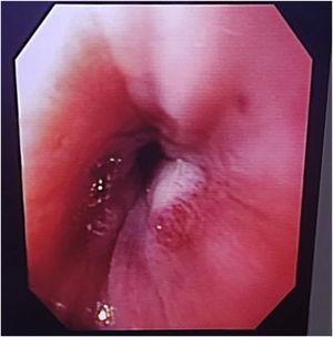 Upper gastrointestinal endoscopy: constrictive esophageal stricture of the lower esophageal sphincter.