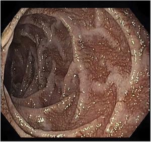 Esophagogastroduodenoscopy showed friable mucosa with granular elevations and thickened and very prominent duodenal folds in the second part of the duodenum.