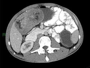 Abdominal CT scan showing an ileocolonic intussusception.