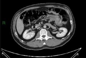 Abdominal CT scan showing a colocolonic intussusception.