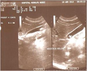 Nineteen-year-old male. Ultrasound study of the gallbladder, showing a mobile hyperechogenic image with posterior acoustic shadowing (gallstone).