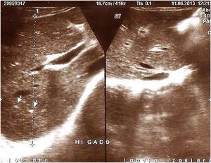 Thirty-two-year-old male. Abdominal ultrasound image showing heterogeneity of the liver parenchyma with periportal hyperechogenicity (white arrows).