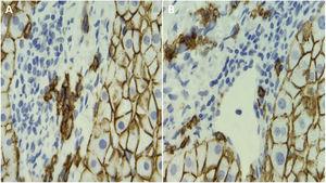Liver tissue stained with CD138 immunohistochemistry. A) Showing plasma cells. B) Showing a liver portal space.