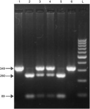 Fragmentos de DNA em eletroforese em gel de agarose após digestão com enzima de restrição no exon 1 do códon 54 do gene da lectina ligante de manose (MBL2). No total, o produto de PCR de 349 pb foi digerido com BanI para o polimorfismo do códon 54. O alelo normal (alelo A) é cortado em dois fragmentos com BanI (faixas 2 e 5), de 89 e 260 pb. O alelo variante (alelo O) permanece sem corte (faixas 1 e 6). Ambos os fragmentos não cortados e digeridos são vistos no AO heterozigoto (faixas 3 e 4). L: escada de DNA de 100 pb.