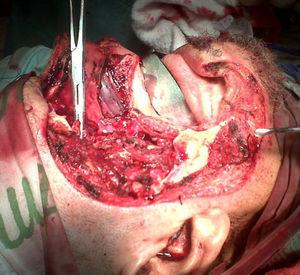 Extensive resection of the tumor that involved the eyeball down to the ramus of the ipsilateral mandible. Source: authors