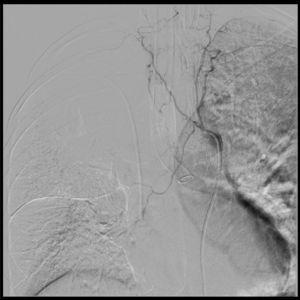 Aortogram and bronchial arteriography. The arteriography enables the selective catheterization of all the bilateral intercostal trunks above and below the left tracheobronchial angle, with failure to catheterize the bronchial artery. This is suggestive of vasospasm and is consistent with the arrest of the active bleeding. The hemorrhage is not visible in the aortogram. Dual lumen tube in the left source bronchus.