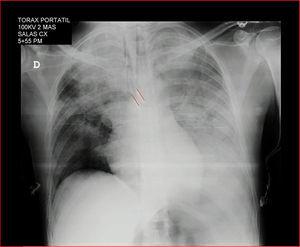 Chest X-ray following the procedure.