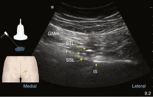 Gluteal ultrasound during pudendal nerve (Pn) recognition. The nerve is deep to the gluteus maximus muscle (GMm), the sacrotuberous ligament (STL), and superficial to the sacrospinous ligament (SSL). The ischial spine (IS) is found lateral to those structures.