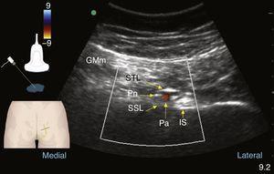Colour Doppler ultrasound at the gluteal level: pudendal nerve (Pn), gluteus maximus muscle (GMm), deep to the sacrotuberous ligament (STL) and superficial to the sacrospinous ligament (SSL); the internal pudendal artery (Pa) and the ischial spine are found lateral to these structures.