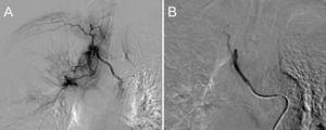 Bronchial arteriography. Hypertrophy of bronchial arteries (right intercostobronchial trunk and right branch of the bronchial trunk) (A). Uneventful embolization of these branches (B).
