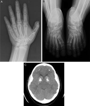 (A) Bone abnormalities in the hand. (B) Bone abnormalities in feet. Note metacarpal and metatarsal defects. (C) Cranial CT. Note calcifications in the basal ganglia.