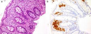 Colorectal mucosa showing a histiocytic infiltrate in the lamina propia (a). Positive CD1a staining in the previously described cellular tissue (b).