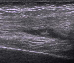 Ultrasound of the right knee, showing a hypoechoic effusion with internal echoes in the right suprapatellar bursa as well as moderate synovial thickening.