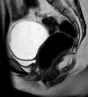 Pelvic MRI. Sagittal T2-weighted image showing an ovarian cyst against the superior portion of the bladder, and the posterior wall of the bladder adjoining the anterior wall of the rectum due to the absence of the uterus and the upper third of the vagina.