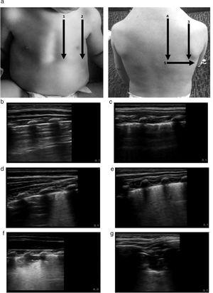 (a) Protocol for lung ultrasound acquisition and interpretation. The scanned zones are marked with numbers. The ultrasound score is noted in the images labelled with letters. The images show the score assigned to each detected abnormality. (b) Normal lung: 0 points. (c) Pleural thickening. LUS-Sc: 1 point. (d) Focal AIS focal. LUS-Sc: 1 point. (e) Diffuse AIS. LUS-Sc: 2 points. (f) SCs<1cm. LUS-Sc: 1 point. (g) SCs>1cm. LUS-Sc: 2 points. AIS, alveolar interstitial syndrome; SC, subpleural consolidation; 1: anterior parasternal zone; 2: anterior axillary zone; 3: posterior axillary zone; 4 posterior paravertebral zone; 5: posterior linea scapularis zone.
