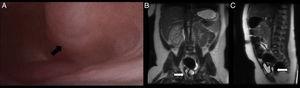 Case 2. (A) Vaginoscopy image showing an obstructed hemivagina (arrow) protruding into the vagina. (B) MRI coronal plane showing a tubular structure in the theoretical location of the vagina with fluid contents (arrow). (C) MRI sagittal view showing a retrovesical tubular structure anterior to the rectum (arrow).