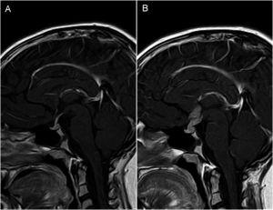 (A and B) MRI imaging in patient with central diabetes insipidus (Patient 8, Table 1). Post-contrast T1-weighted sagittal view, with 24 months elapsed between scans. (A) Initial MRI scan at diagnosis: no abnormal findings, with normal pituitary stalk. (B) Marked thickening of pituitary stalk with nodular enhancement suggestive of neoplastic disease (germinoma eventually confirmed by biopsy). Absence of hyperintense spot corresponding to posterior pituitary in T1-weighted images.