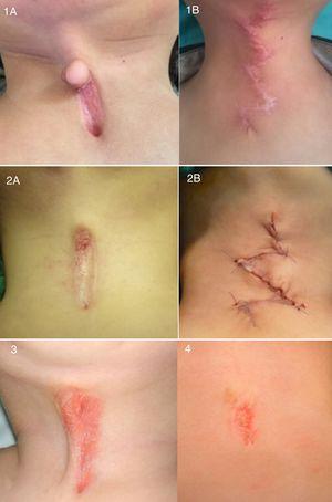 Patient 1: (A) MCC with superior nipple-like skin projection. (B) Z-plasty in case 1, 1 month post surgery, allowing cervical retraction and mobility. Patient 2: (A) MCC with very small superior nipple-like skin tag. (B) Z-plasties in case 2 after finishing surgical treatment. Patient 3: MCC hindering cervical extension. Patient 4: Small MCC manifesting with neck hyperextension.