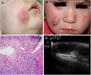 (A) Clinical image of case 2. (B) Clinical image of case 6 showing a chalazion in the right lower eyelid. (C) Histological examination of the lesion in the right cheek of case 6, showing a cutaneous infiltrate of lymphocytes and plasma cells with granulomas composed of histocytes and multinucleate giant cells. (D) Ultrasound of lesion in the right cheek (case 6) showing a hypoechoic structure with a rolled posterior edge.