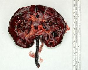 Macroscopic description: nephrectomy specimen cut at the hilum with a 2×2cm mass located in the renal pelvis, with areas with a necrotic appearance.