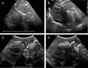 Abdominal ultrasound scan revealing portal gas and intestinal pneumatosis: Note the presence of numerous air bubbles in the peripheral branches of the left portal vein, in the form of dots (A) or as streaks in a branching pattern over the right lobe of the liver (B) Liver pattern resembling an air bronchogram. Bubbles are trapped in the narrow peripheral portal vessels and can be visualized, even if gas is not moving during performance of the ultrasound. Intestinal pneumatosis appearing as isolated foci (C) or clustered foci in the bowel loop walls (D). (Appendix B, supplemental material, video.)