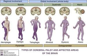 Types of cerebral palsy and affected areas of the brain.