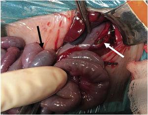 Gastric perforation. The nasogastric tube (white arrow) could be seen through the gastric perforation on the greater curvature in a patient with meconium ileus (black arrow).