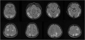 Magnetic resonance images obtained in the 2 presented cases. Long TR sequence (T2-weighted and FLAIR) images from patient 1 (A) and patient 2 (B) showing symmetrical areas of cortico-subcortical hyperintensity in the temporo-occipital and frontoparietal regions of both cerebral hemispheres, compatible with posterior reversible encephalopathy syndrome.