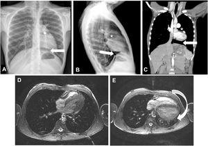 (A–C) Chest radiography, posteroanterior (A) and lateral (B); cardiac CT (C); leftward shift of the heart with lung interposition between the aorta and the pulmonary artery (*) and interposition of lung parenchyma between the left diaphragm and the border of the base of the left heart (arrow). (D) Cardiac MRI with the patient in the right lateral decubitus position. (E) Cardiac MRI with patient in supine position showing posterior shift of the cardiac silhouette (arrow).