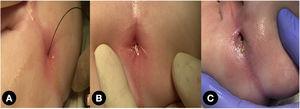 (A) Neoanus after the first 6 mm balloon dilatation and (B) cardinal sutures at the mucocutaneous junction. (C) Appearance after 5 months of dilations.
