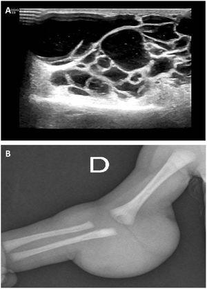 Ultrasound scan and plain radiograph of the lesion. (A) Ultrasound scan of the right upper extremity: multicystic lesion measuring 52 × 34 × 52 mm (CC × AP × TR), predominantly avascular, located in the subcutaneous tissue of the posterior elbow and extending into the adjacent compartments. No involvement of bone, joints or muscle tissue. (B) Plain radiograph of the right upper extremity showing a tumour in the right elbow.