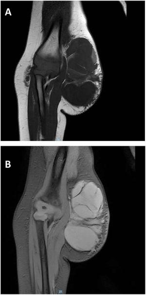 Magnetic resonance imaging of the lesion. (A) Fat-suppressed proton density-weighted T1-weighted image. (B) Gradient echo T2-weighted image.