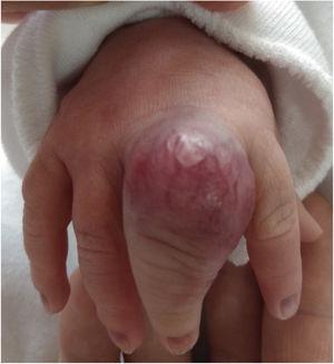 Involution of congenital hemangioma at birth.