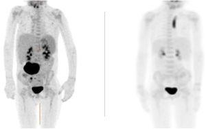 (A) PET-CT: mesenteric mass measuring 6 × 4 × 6 cm at diagnosis. (B) PET-CT: complete resolution after 4 months of crizotinib.
