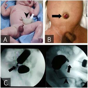Umbilical cord with a large cyst measuring 7 × 4.5 cm (A, arrowhead) and umbilical granuloma exuding a yellowish fluid after the cord stump fell off (B, arrow). The fistulogram confirmed the presence of patent urachus (C, arrow) in absence of urethral anomalies (C, arrowhead). The upper and lateral portions of the latter image feature a radiolucent tubular structure, corresponding to the syringe used to inject the contrast agent.