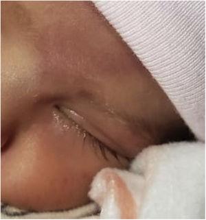 Female neonate with swelling of the left eyelid at 7 days post birth.