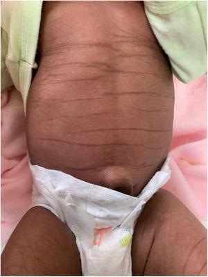Generalised hyperpigmentation along the creases of the abdomen at 1 month post birth.
