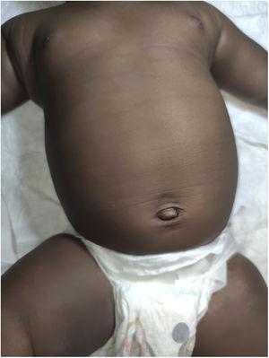 Fading hyperpigmented abdominal creases at 4 months post birth.