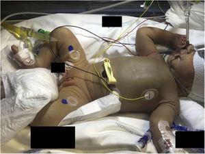 Discoloration in a preterm newborn exposed to phototherapy. Diaper-covered areas were not affected.
