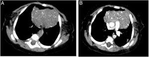 Axial computed tomography scan of the chest without contrast (A) and with contrast (B) evincing thymus hypertrophy. There were multiple punctate calcifications in the thymus, characteristic of Langerhans cell histiocytosis in this organ.