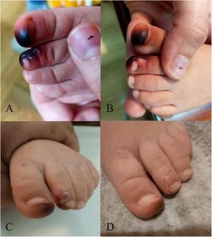 Pigmentation caused by contact with a beetle of the Coleoptera family, from the day of presentation (A) to resolution a few weeks later (D). Blackish stain with well-defined borders in the first and second toes, with a vesicle in the second toe (A).